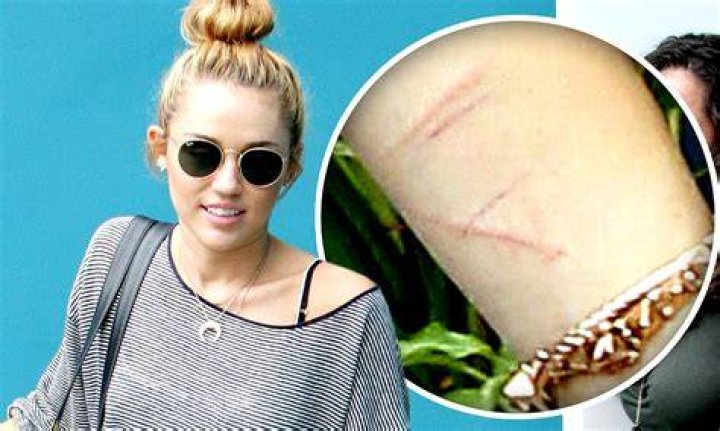 Celebrities With Self Harm Scars Our Vinyl Weighs A Ton