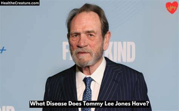 Does Tommy Lee Jones have cancer?