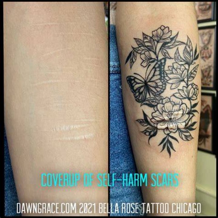 Uncovering Colby Self Harm Scars: Insights And Discoveries For Healing